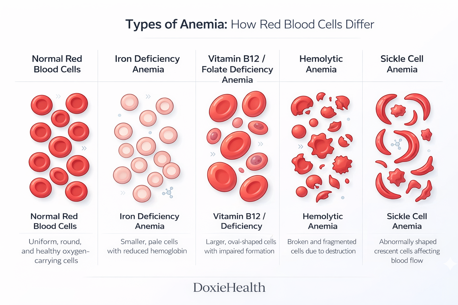 Comparison of red blood cell appearance in different types of anemia including iron deficiency anemia, vitamin B12 deficiency, hemolytic anemia, and sickle cell anemia